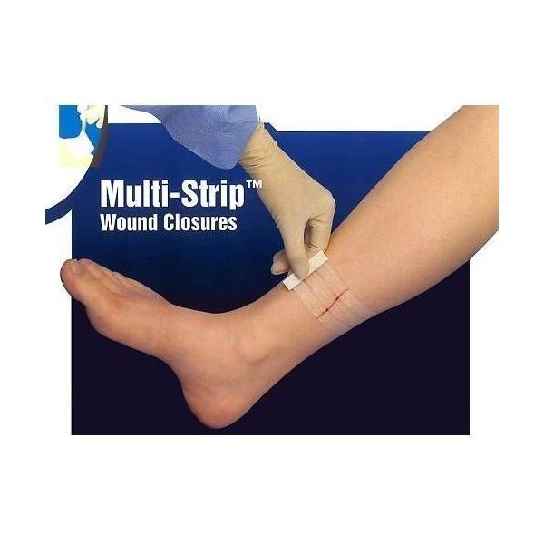 Multi-Strip Wound Strip 3mmx75mm 5/Strip