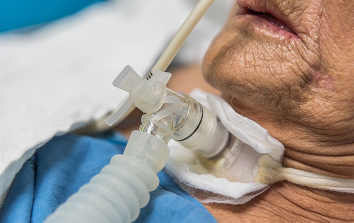 Tracheostomy